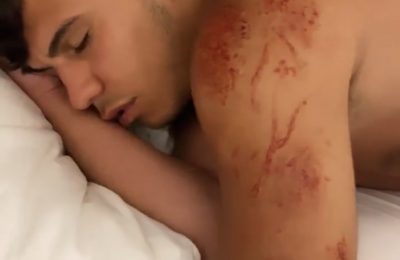 Популярный блогер потерял сознание от укуса медузы во время отдыха